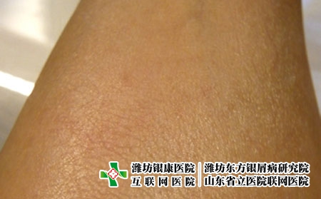 鱼鳞病的发病症状是什么，鱼鳞病刚开始什么样