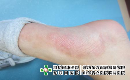潍坊市看牛皮癣较为正规医院有什么，潍坊银康医院怎么样