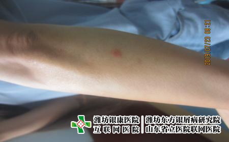 牛皮癣的具体危害有哪些，牛皮癣后果严重吗