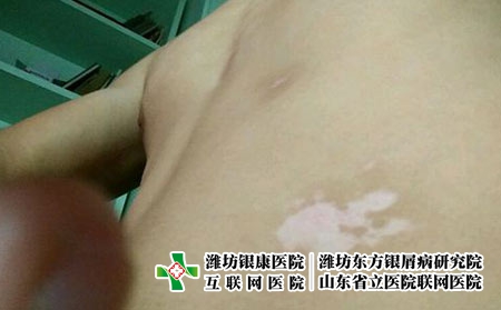 患者在发现白癜风后应该如何治疗，有白癜风怎么办