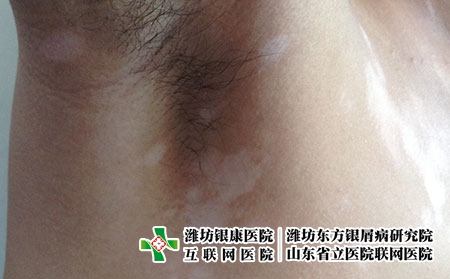 应对局限性白癜风有哪些方法，白癜风应该怎么治