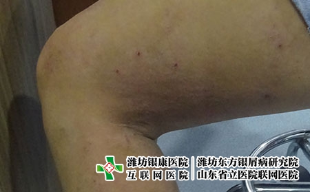 湿疹这种皮肤病主要有哪些类型，湿疹都有什么样