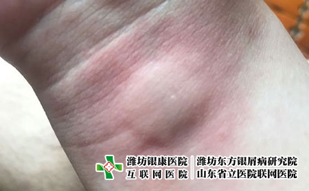 荨麻疹怎么才能快点好，荨麻疹怎么辅助治疗