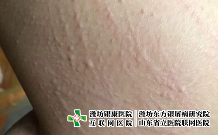 要避免荨麻疹的困扰该怎么办,什么能避免荨麻疹发作 要避免荨麻疹的困扰该怎么办,什么能避免荨麻疹发作