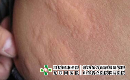 荨麻疹治好了又发作怎么办，怎么治疗荨麻疹正确