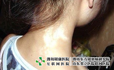 要怎么做可以治疗好白癜风，怎么治白癜风好的快