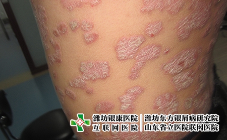 牛皮癣如何预防，牛皮癣好了还要注意什么