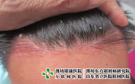 面部牛皮癣护理的方法，脸上牛皮癣怎么办