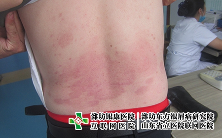 哪里治疗牛皮癣好，潍坊好的牛皮癣医院有哪些