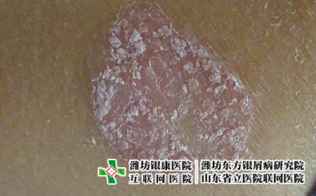 牛皮癣有哪些类型，什么样的是牛皮癣