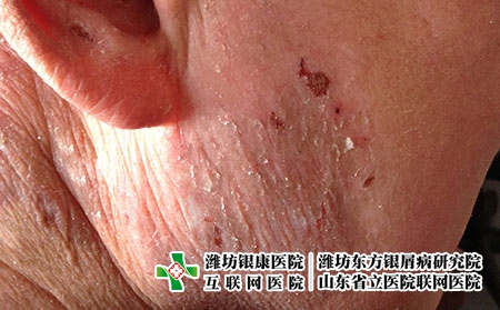 在潍坊看过敏性皮炎要多少钱，治过敏皮炎要准备多少钱