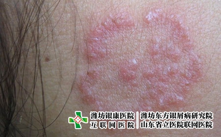体癣病症呈现的症状特点，体癣是什么样