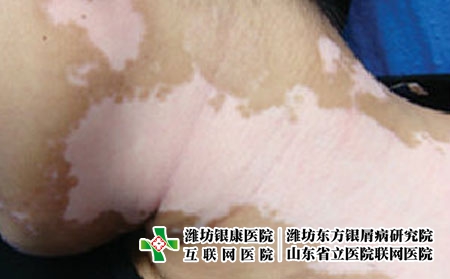 白癜风怎么治才能尽快好转，白癜风怎么尽快消退