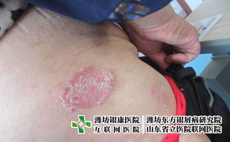 牛皮癣初期怎么治疗，刚确诊了牛皮癣怎么治