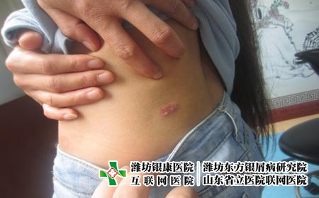 牛皮癣怎样预防，牛皮癣好了还有什么禁忌