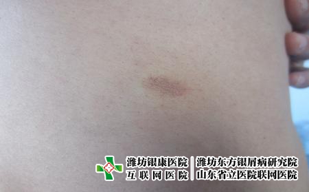 牛皮癣的表现是什么，什么样的癣是牛皮癣