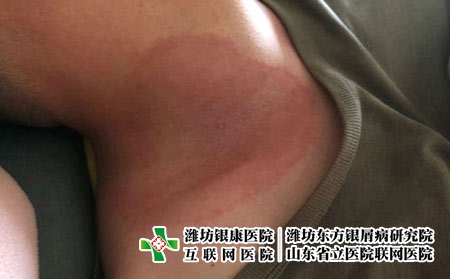 在潍坊如何预防日光性皮炎皮肤病，皮炎平时要注意什么