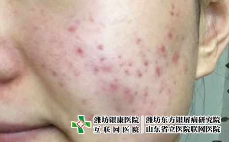 怎么有效地护理神经性皮炎呢，有皮炎日常怎么护理