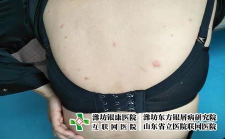 潍坊看牛皮癣大概要花多少钱，潍坊银康治牛皮癣省钱