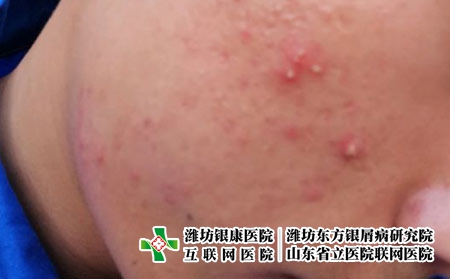 女性患上痤疮的原因，为什么痤疮老反复