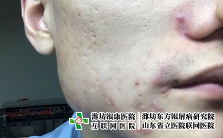 如何防止脸上反复长痤疮，痤疮怎么预防