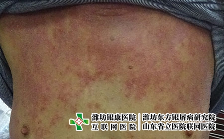 天气转热后如何预防湿疹复发，夏天湿疹爱复发怎么办