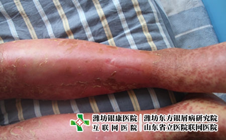 牛皮癣关节炎可分为哪几个类型，关节型牛皮癣是怎么样的