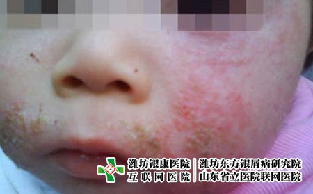 婴儿长湿疹是怎么回事，怎么治疗婴儿湿疹好