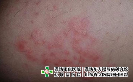 30患了皮肤过敏该如何调理呢，易过敏平时怎么避免