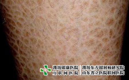 潍坊银康皮肤病医院介绍：鱼鳞病护理方法有哪些