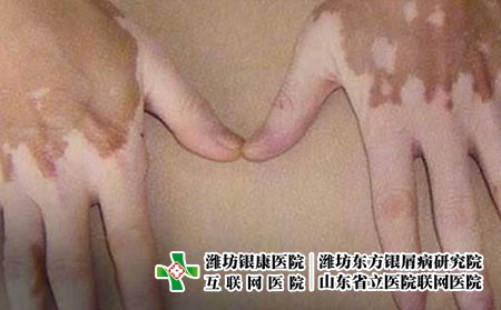 白癜风平时要避免什么，白癜风的日常护理