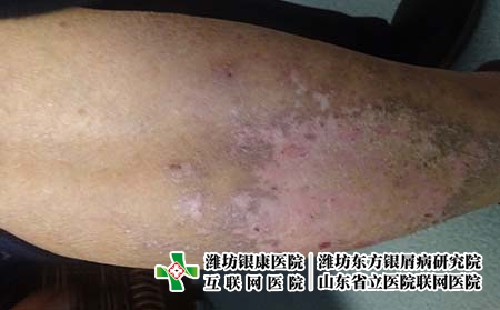 潍坊牛皮癣治疗得多少钱，潍坊银康治疗牛皮癣不贵