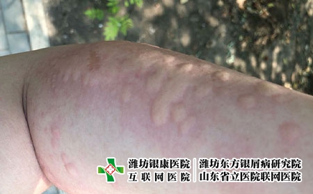 荨麻疹是什么原因导致的，为什么荨麻疹总是发作