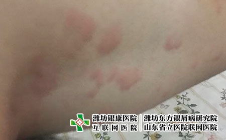 潍坊如何选择医院治疗荨麻疹,潍坊银康医院有专长 潍坊如何选择医院治疗荨麻疹,潍坊银康医院有专长
