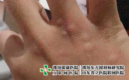 潍坊治疗荨麻疹哪个医院好,潍坊皮肤病医院银康优选 潍坊治疗荨麻疹哪个医院好,潍坊皮肤病医院银康优选