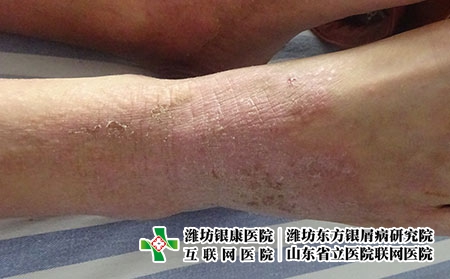 得了湿疹去哪里治疗，潍坊银康医院治湿疹不反复