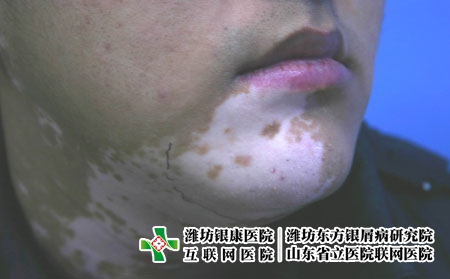 该怎么做才能脱离白癜风折磨，白癜风怎么好得快