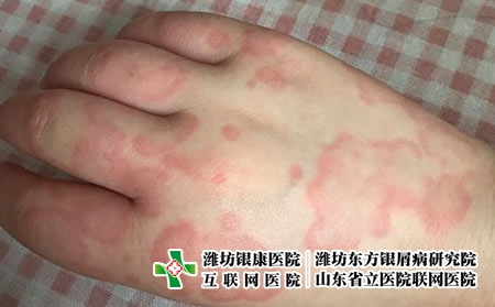 治疗荨麻疹需要多少钱，潍坊银康皮肤病医院治荨麻疹费用