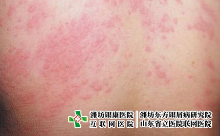 荨麻疹的预防措施有哪些，易得荨麻疹怎么避免