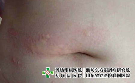 荨麻疹应该怎么治，潍坊银康皮肤病医院治荨麻疹怎么样