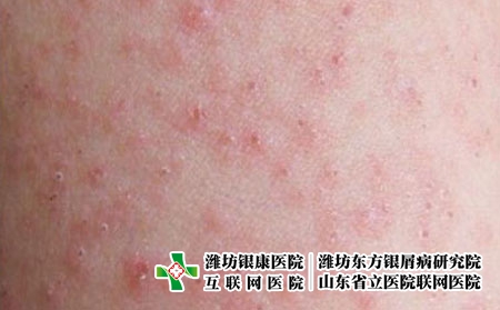 荨麻疹如何有效的避免,怎么预防荨麻疹的复发 荨麻疹如何有效的避免,怎么预防荨麻疹的复发