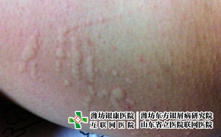 皮肤过敏应该怎么办，潍坊银康怎么避免皮肤过敏
