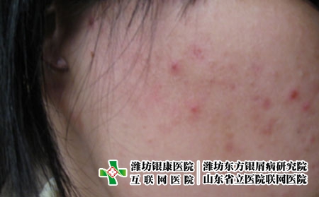 出现大量痤疮的原因是什么，为什么痘痘越来越严重