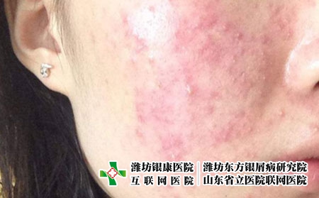 容易造成痤疮发生的三大因素，潍坊银康讲解痘痘的成因