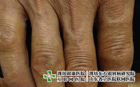 为什么湿疹总是反复，潍坊银康解答湿疹的诱因