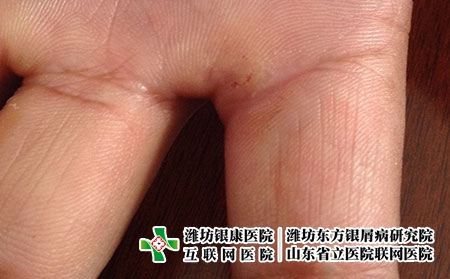 为什么湿疹会复发，湿疹季节性反复是因为什么