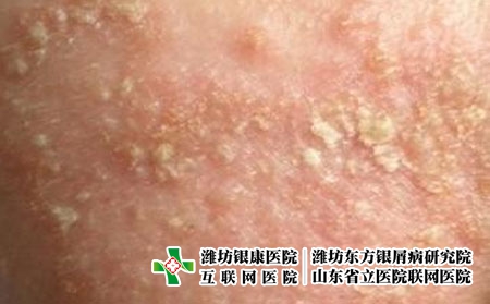 皮炎有哪些注意事项，得了皮炎的生活禁忌