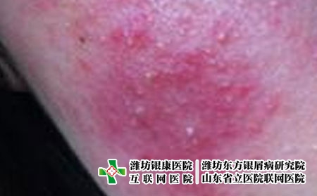 皮肤过敏应该要怎么护理，皮肤过敏平时怎么防护