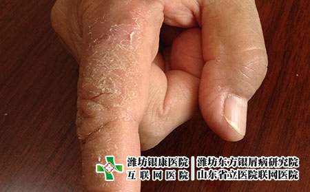 引发湿疹的因素有哪些，为什么会得湿疹