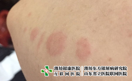 哪些原因会诱发皮炎的发生,皮炎是怎么得的 哪些原因会诱发皮炎的发生,皮炎是怎么得的